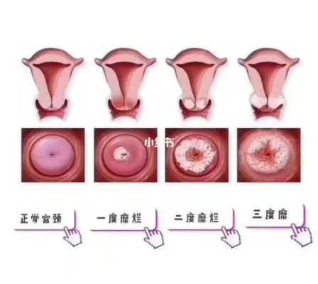 子宫糜烂的症状有哪些呢,怀孕期间宫颈糜烂症状有哪些 第2张 子宫糜烂的症状有哪些呢,怀孕期间宫颈糜烂症状有哪些 第2张