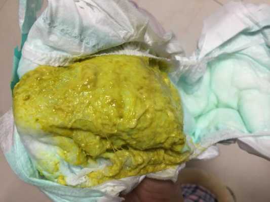 胎儿不排便(新生儿12小时没有大便这种情况正常的吗) 第1张 胎儿不排便(新生儿12小时没有大便这种情况正常的吗) 第1张