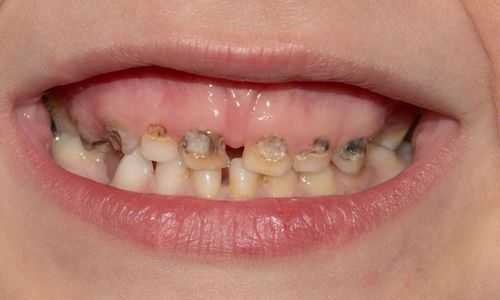 孕期牙齿变黑了怎么办(生完孩子后牙齿有些发黑) 第2张 孕期牙齿变黑了怎么办(生完孩子后牙齿有些发黑) 第2张