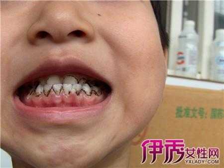 孕期牙齿变黑了怎么办(生完孩子后牙齿有些发黑) 第1张 孕期牙齿变黑了怎么办(生完孩子后牙齿有些发黑) 第1张