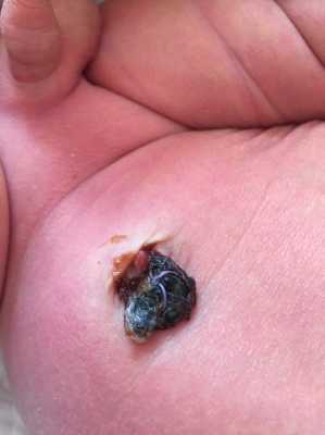 胎儿脐带脱落(新生儿脐带什么时候脱落) 第1张 胎儿脐带脱落(新生儿脐带什么时候脱落) 第1张