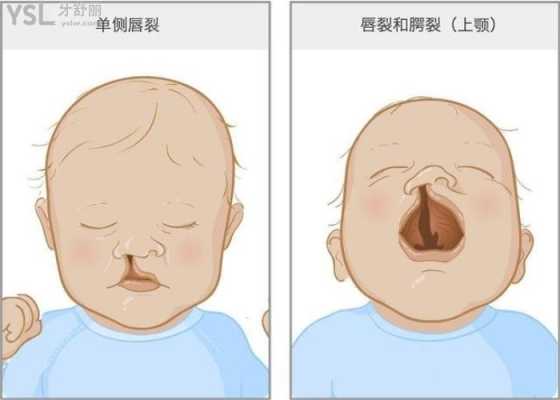 胎儿下嘴唇裂(胎儿下嘴唇裂开怎么办) 第2张 胎儿下嘴唇裂(胎儿下嘴唇裂开怎么办) 第2张