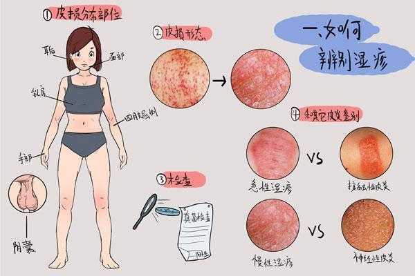 孕期乳晕长湿疹怎么办(孕期乳晕长湿疹怎么办啊) 第1张 孕期乳晕长湿疹怎么办(孕期乳晕长湿疹怎么办啊) 第1张