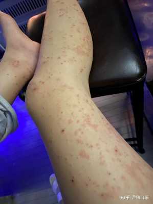 孕期全身长湿疹怎么办(孕妇阴部得了湿疹怎么办) 第1张 孕期全身长湿疹怎么办(孕妇阴部得了湿疹怎么办) 第1张