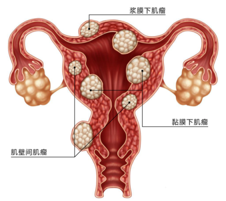 怀孕期间长了子宫肌瘤(怀孕后检查出子宫肌瘤有影响吗) 第1张 怀孕期间长了子宫肌瘤(怀孕后检查出子宫肌瘤有影响吗) 第1张