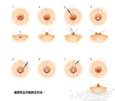 孕期乳头凹陷怎么办啊(孕期乳头凹陷怎么办啊) 第1张 孕期乳头凹陷怎么办啊(孕期乳头凹陷怎么办啊) 第1张
