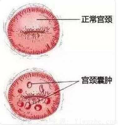 宫颈肥大影响胎儿吗(子宫颈肥大什么意思) 第2张 宫颈肥大影响胎儿吗(子宫颈肥大什么意思) 第2张