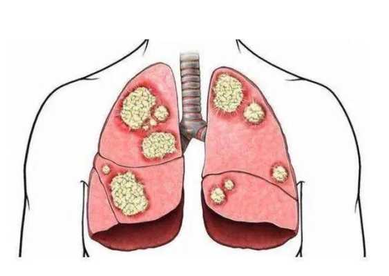 胎儿胸腔积液的原因(肺积水的原因是什么) 第2张 胎儿胸腔积液的原因(肺积水的原因是什么) 第2张