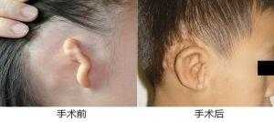 宝宝耳朵怎么会畸形的啊？怀孕期间需要注意哪些呢,检查胎儿畸形的方法有哪些  第2张