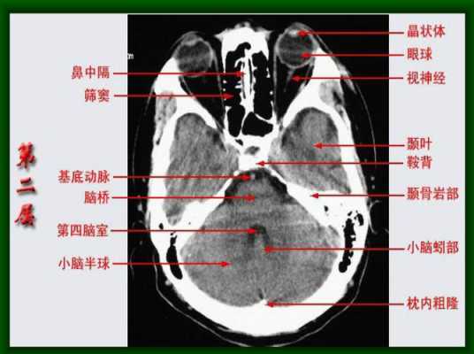 正常成人大脑中存在帆腔吗,胎儿大脑中帆腔怎么办  第3张