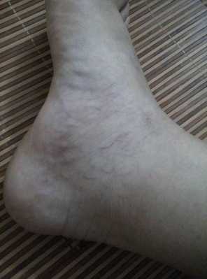 孕期脚踝肿了怎么办(孕妇脚和脚腕有红血丝) 第1张 孕期脚踝肿了怎么办(孕妇脚和脚腕有红血丝) 第1张