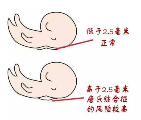 胎儿颈项皮肤增厚(胎儿颈项皮肤增厚什么意思) 第1张 胎儿颈项皮肤增厚(胎儿颈项皮肤增厚什么意思) 第1张