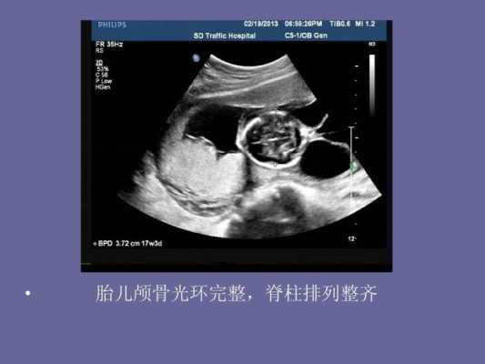 胎儿颅骨光环是什么(胎儿颅骨光环是什么意思) 第1张 胎儿颅骨光环是什么(胎儿颅骨光环是什么意思) 第1张