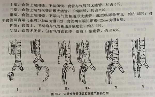 如何发现食管闭锁,胎儿食道闭锁的原因有哪些 第1张 如何发现食管闭锁,胎儿食道闭锁的原因有哪些 第1张