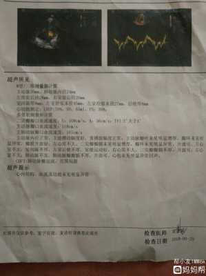 孕期心脏彩超能检查出什么(孕期心脏彩超能检查出什么毛病) 第2张 孕期心脏彩超能检查出什么(孕期心脏彩超能检查出什么毛病) 第2张