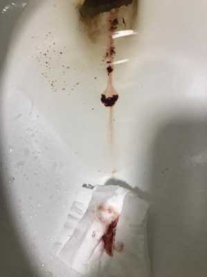 备孕期间出血什么情况（备孕期间出血什么情况啊）  第3张