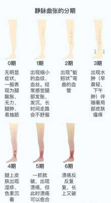 孕期静脉曲张怎么治疗(怀孕后外阴静脉曲张该怎么缓解) 第1张 孕期静脉曲张怎么治疗(怀孕后外阴静脉曲张该怎么缓解) 第1张