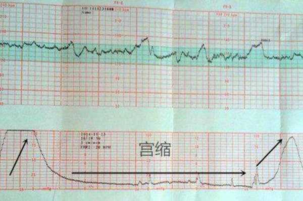 总是担心胎儿不健康(胎心监护正常胎儿就不会缺氧吧) 第2张 总是担心胎儿不健康(胎心监护正常胎儿就不会缺氧吧) 第2张