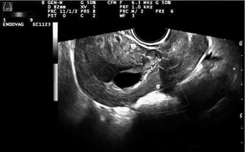 子宫肌瘤中CDFI:周边可见带状血流信号,孕妇宫腔内带状分隔 第2张 子宫肌瘤中CDFI:周边可见带状血流信号,孕妇宫腔内带状分隔 第2张