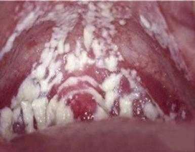孕期白带黄绿色豆腐渣(孕期分泌物黄绿色豆腐渣) 第2张 孕期白带黄绿色豆腐渣(孕期分泌物黄绿色豆腐渣) 第2张