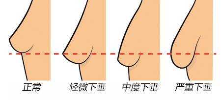 怀孕期间乳房会下垂吗（怀孕期间乳房会下垂吗图片）  第3张