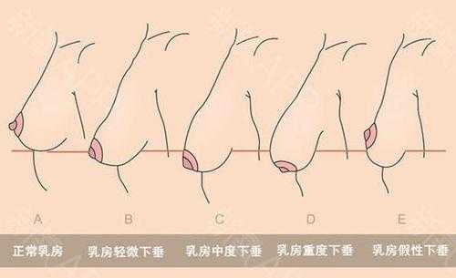 怀孕期间乳房会下垂吗（怀孕期间乳房会下垂吗图片）  第2张