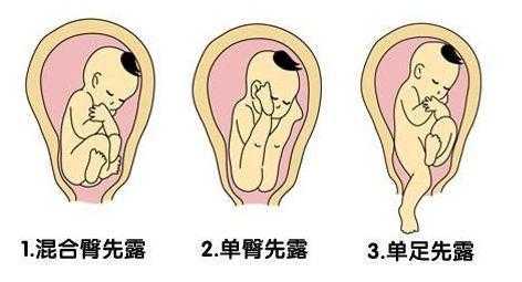 32周胎儿的头在哪里?怀孕32周,臀位怎么办,孕妇32周胎儿图片 第3张 32周胎儿的头在哪里?怀孕32周,臀位怎么办,孕妇32周胎儿图片 第3张