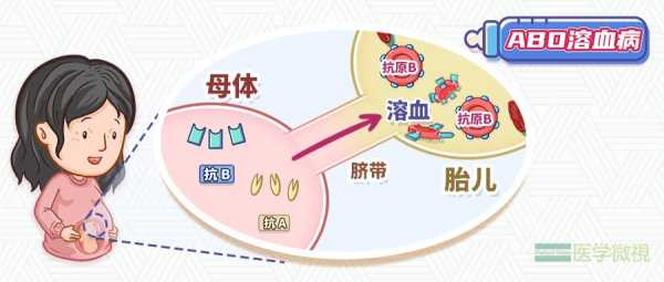 胎儿溶血怎么治疗(胎儿溶血怎么治疗方法) 第1张 胎儿溶血怎么治疗(胎儿溶血怎么治疗方法) 第1张