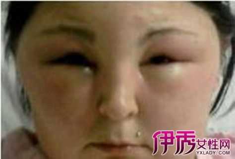 胎儿水肿有什么症状（两岁的宝宝眼皮浮肿需要做哪些检查）  第2张