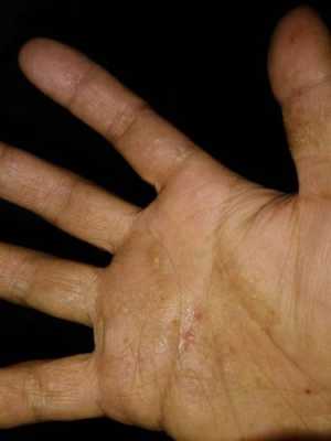 孕期手上起了湿疹怎么办(手上长湿疹怎么办) 第2张 孕期手上起了湿疹怎么办(手上长湿疹怎么办) 第2张