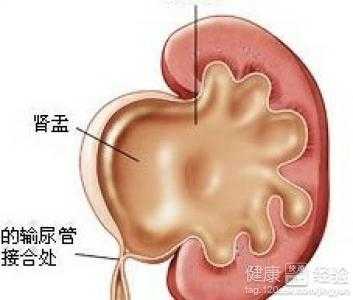 胎儿肾积水是男孩吗（胎儿肾积水是男孩吗?）  第1张