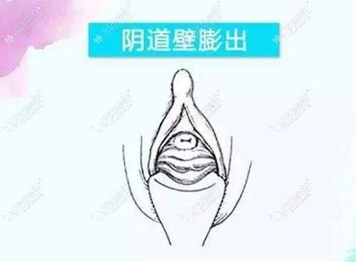 会阴部突然坠胀是怎么回事,孕期阴壁膨出什么原因引起的 第1张 会阴部突然坠胀是怎么回事,孕期阴壁膨出什么原因引起的 第1张