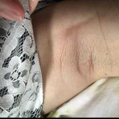 怀孕期间胳肢窝变黑(怀孕期间胳肢窝变黑怎么回事) 第2张 怀孕期间胳肢窝变黑(怀孕期间胳肢窝变黑怎么回事) 第2张