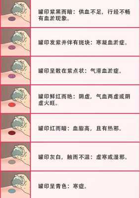 怀孕期间能拔罐吗(怀孕的时候还能够拔罐吗) 第2张 怀孕期间能拔罐吗(怀孕的时候还能够拔罐吗) 第2张