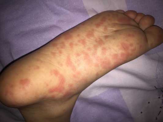 怀孕期间脚上长红点点(怀孕后手心脚心发热是怎么回事?怀孕后手心脚心发热是正常的吗) 第2张 怀孕期间脚上长红点点(怀孕后手心脚心发热是怎么回事?怀孕后手心脚心发热是正常的吗) 第2张