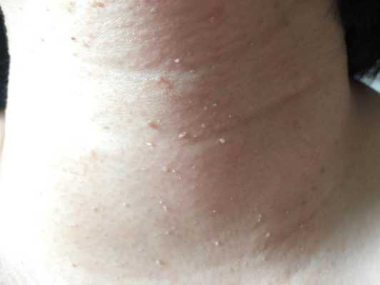 怀孕期间脖子上长肉丁(怀孕期间脖子上长肉丁怎么回事) 第3张 怀孕期间脖子上长肉丁(怀孕期间脖子上长肉丁怎么回事) 第3张