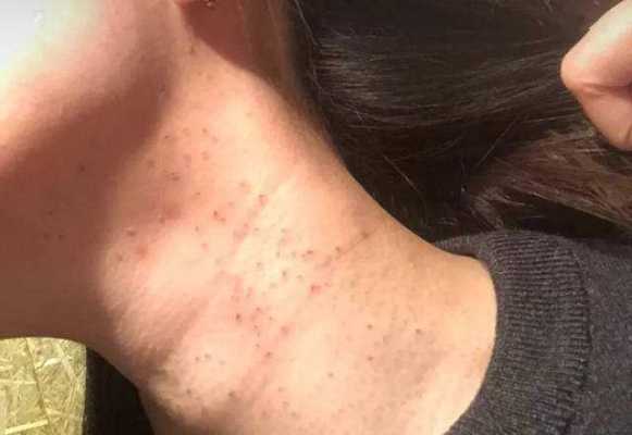 怀孕期间脖子上长肉丁(怀孕期间脖子上长肉丁怎么回事) 第2张 怀孕期间脖子上长肉丁(怀孕期间脖子上长肉丁怎么回事) 第2张
