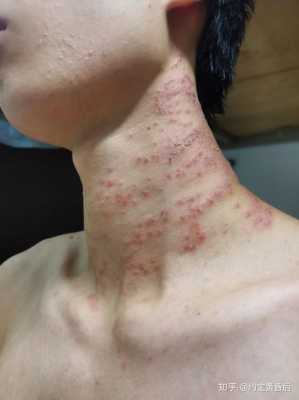 备孕期间男方吃了治疗湿疹的药，会对胚胎有影响吗,备孕期间阴部痒怎么办啊  第2张