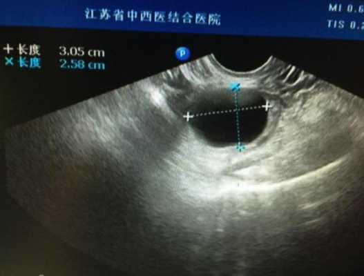 卵巢囊肿影响胎儿发育(卵巢囊肿影响胎儿发育吗) 第1张 卵巢囊肿影响胎儿发育(卵巢囊肿影响胎儿发育吗) 第1张