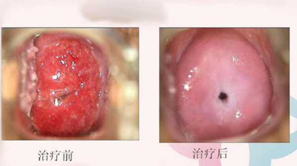 怀孕期间宫颈炎症状（宫颈炎早期症状有哪些）  第1张