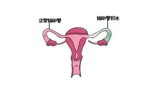 怀孕期间输卵管疼（输卵管通液很痛怎么回事）  第1张