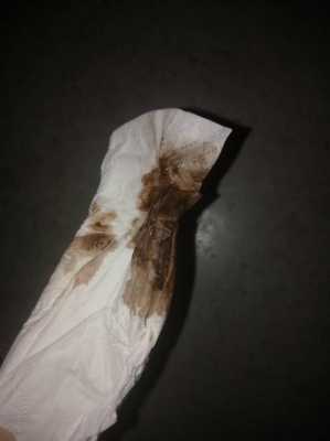 怀孕期间出血是黑色的(怀孕了一直有褐色的血怎么回事) 第2张 怀孕期间出血是黑色的(怀孕了一直有褐色的血怎么回事) 第2张