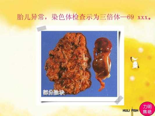 69三倍体胎儿（69三倍体胎儿XXY）  第3张