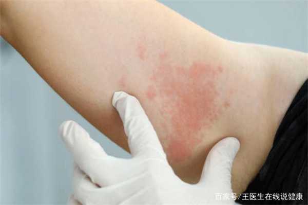 孕妇得带状疱疹对胎儿有什么影响,孕妇泡疹会影响胎儿吗 第2张 孕妇得带状疱疹对胎儿有什么影响,孕妇泡疹会影响胎儿吗 第2张