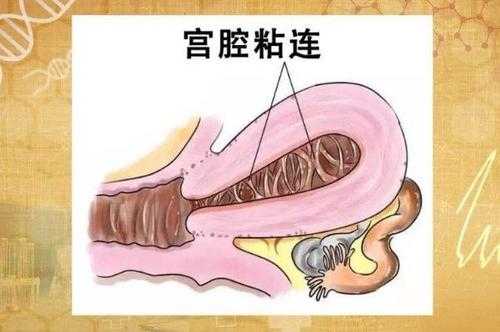 怀孕期间宫腔粘连带(怀孕期间宫腔粘连带怎么办) 第1张 怀孕期间宫腔粘连带(怀孕期间宫腔粘连带怎么办) 第1张