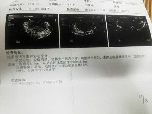 怀孕期间宫腔粘连带(怀孕期间宫腔粘连带怎么办) 第3张 怀孕期间宫腔粘连带(怀孕期间宫腔粘连带怎么办) 第3张