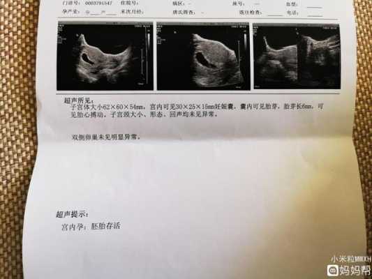 孕期四十天没胎心胎芽(怀孕42天还没有胎心胎芽,怎么办) 第2张 孕期四十天没胎心胎芽(怀孕42天还没有胎心胎芽,怎么办) 第2张