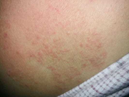 孕期过敏性湿疹怎么办(孕期过敏性湿疹怎么办啊) 第2张 孕期过敏性湿疹怎么办(孕期过敏性湿疹怎么办啊) 第2张
