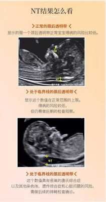 检查胎儿畸形的检查方法（检查胎儿畸形的检查方法有哪些）  第1张