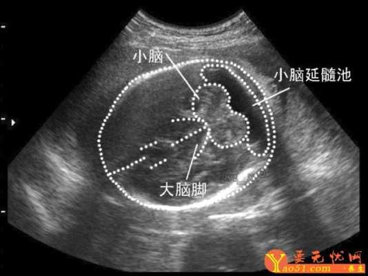 胎儿小脑蚓部发育时间(胎儿小脑蚓部发育时间) 第1张 胎儿小脑蚓部发育时间(胎儿小脑蚓部发育时间) 第1张